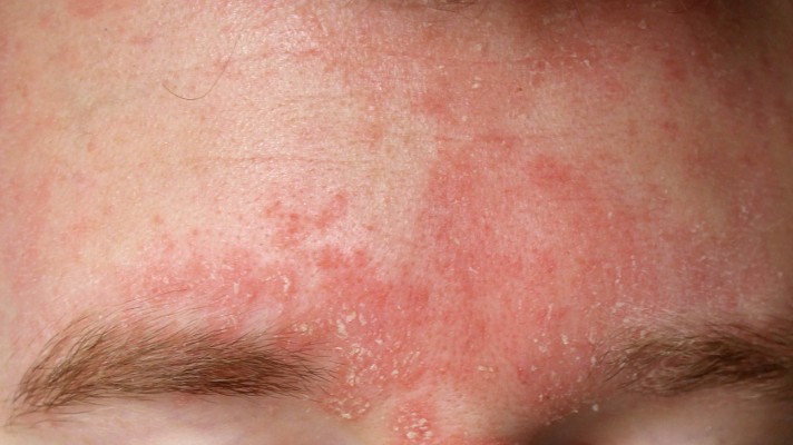 DERMATITES